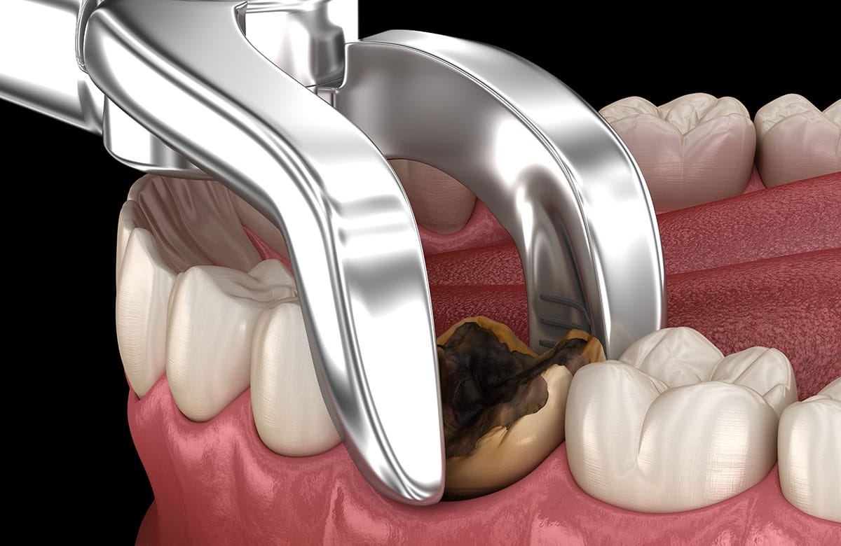 tooth-extraction image